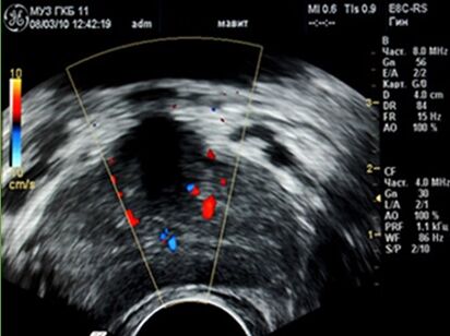 Ultrasound showed foci of inflammation in the prostate. 