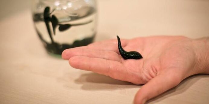 Treatment with leeches