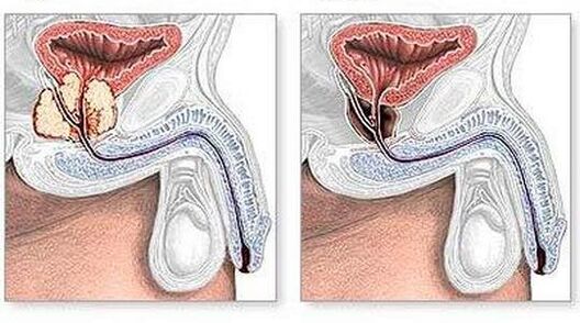 Before and after the treatment of surgically chronic prostatitis