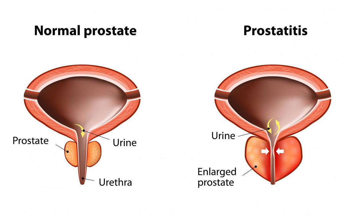 Normal prostate of a healthy man and inflammation of the prostate with prostatitis.