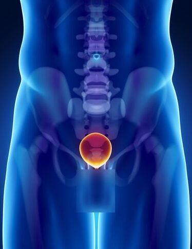 Inflammation of the prostate in a man with prostatitis. 