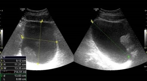 Postatitis signs for ultrasound